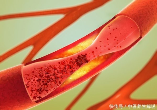 升富配资 三高控制良好，为何也突然心梗了？医生：别忘了这个指标